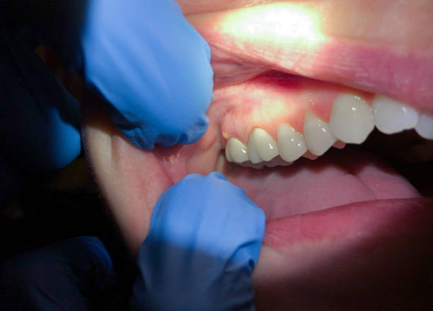 Best Emergency Dental Services for Seniors in Ellenville, NY